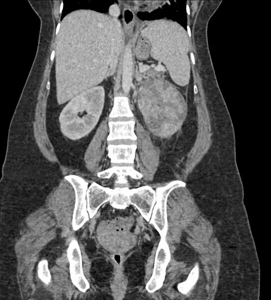 File:Acute pyelonephritis with renal vein thrombosis (Radiopaedia 58020-65053 Coronal renal parenchymal phase 66).jpg
