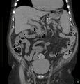 Acute renal failure post IV contrast injection- CT findings (Radiopaedia 47815-52557 Coronal non-contrast 17).jpg