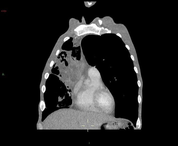File:Acute right lung abscess (Radiopaedia 34806-36258 Coronal C+ arterial phase 44).jpg