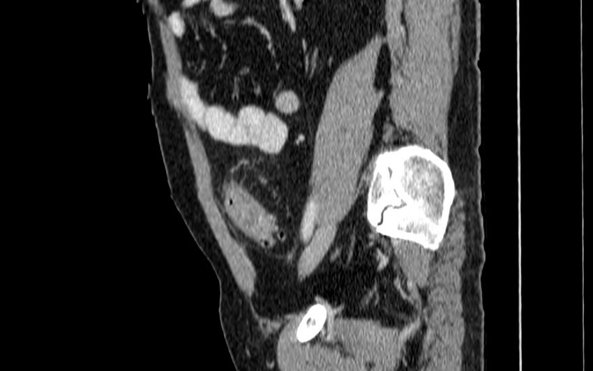 Acute sigmoid colon diverticulitis (Radiopaedia 55507-61976 Sagittal C+ portal venous phase 55).jpg