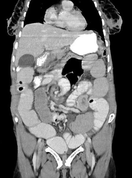 File:Acute small bowel (ileal) volvulus (Radiopaedia 71740-82139 Coronal C+ portal venous phase 42).jpg