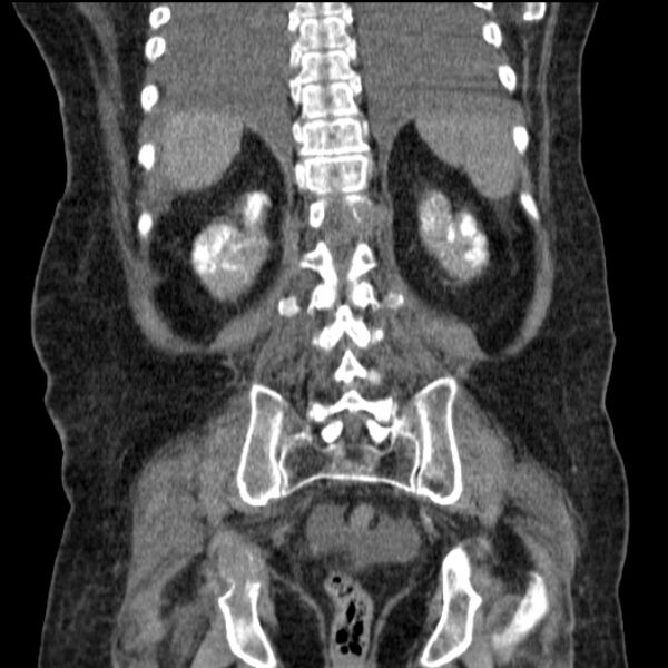 File:Acute tubular necrosis (Radiopaedia 28077-28334 D 64).jpg