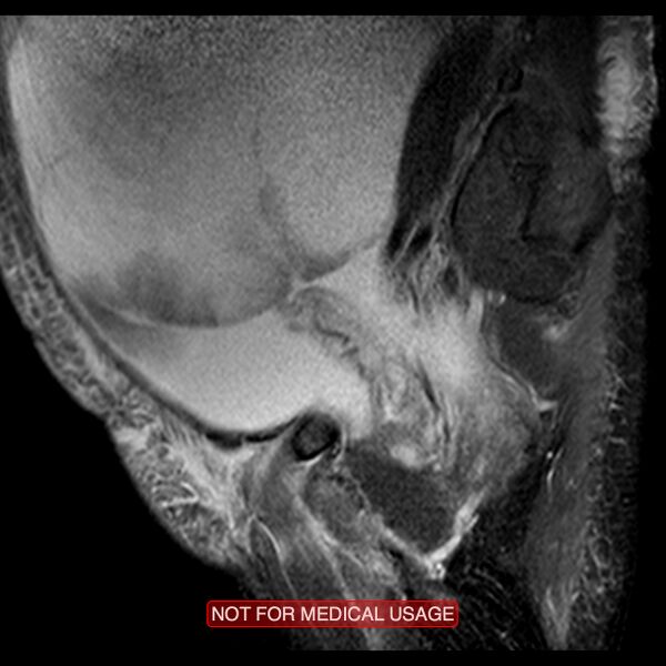 File:Adenocarcinoma of the cervix (Radiopaedia 28373-28615 Sagittal T2 fat sat 16).jpg