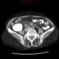 Adenocarcinoma of the colon (Radiopaedia 8191-9039 Axial renal excretory phase 35).jpg