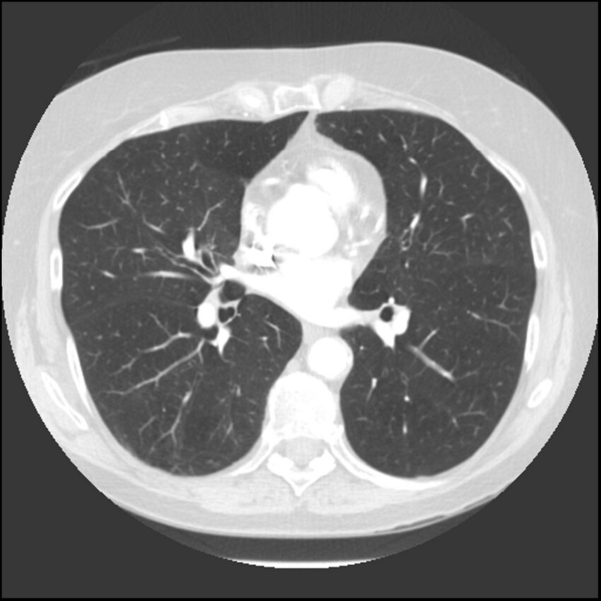 Adenocarcinoma of the lung (Radiopaedia 41015-43755 Axial lung window 67).jpg