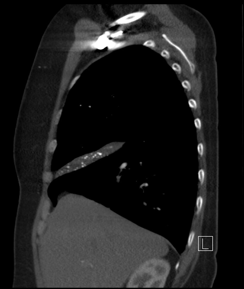 Adenocarcinoma of the lung (Radiopaedia 44205-47803 Sagittal C+ portal venous phase 41).jpg