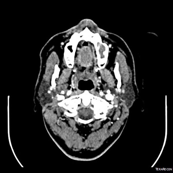 File:Adenoid cystic carcinoma involving paranasal sinus (Radiopaedia 16580-16283 Axial C+ arterial phase 9).jpeg