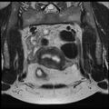 Adenoma malignum of the cervix (Radiopaedia 24460-24765 Coronal T2 6).jpg