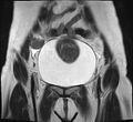 Adenomyosis - ovarian endometriomas (Radiopaedia 67031-76350 Coronal T2 5).jpg