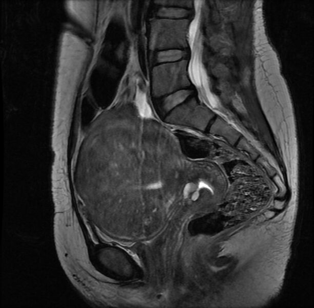 File:Adenomyosis on MRI (Radiopaedia 29328-29780 Sagittal T2 9).jpg