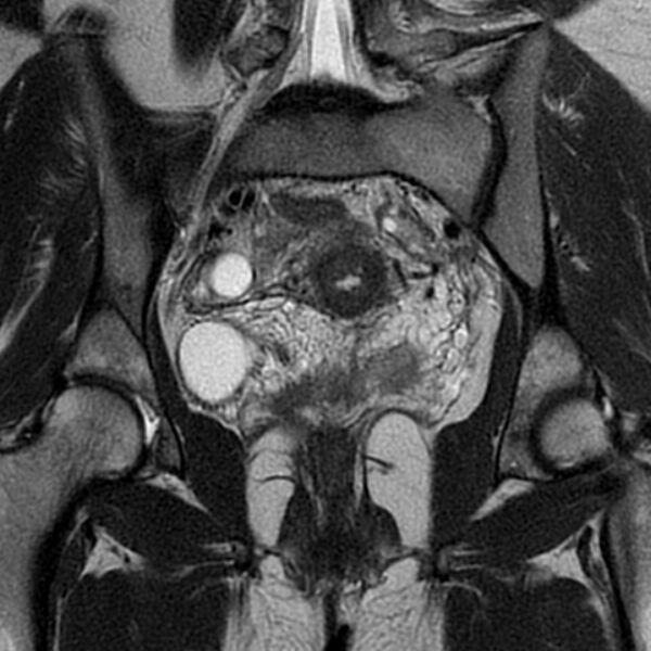 File:Adenomyosis within a septate uterus (Radiopaedia 69963-79981 Coronal T2 19).jpg