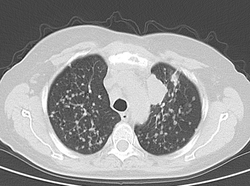 File:Adenosquamous lung carcinoma (Radiopaedia 22035-22030 lung window 22).jpg