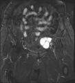 Adnexal multilocular cyst (O-RADS US 3- O-RADS MRI 3) (Radiopaedia 87426-103754 Coronal T2 fat sat 9).jpg