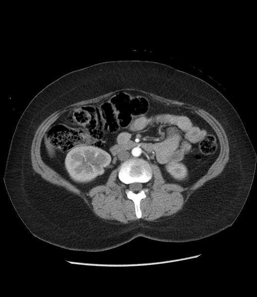 File:Adrenal cortical carcinoma with IVC invasion and thrombosis (Radiopaedia 34307-35597 Axial C+ arterial phase 44).jpg