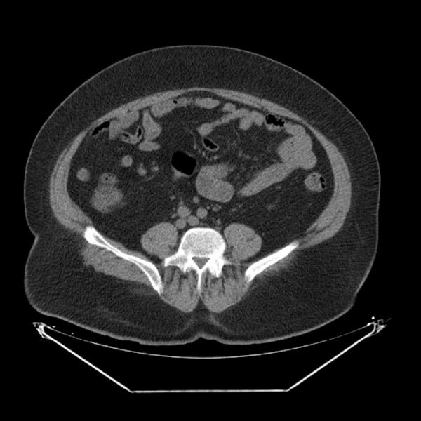File:Adrenal myelolipoma (Radiopaedia 26278-26407 Axial non-contrast 46).jpg