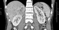 Adrenal pheochromocytoma (Radiopaedia 35133-36726 Coronal C+ portal venous phase 24).jpg