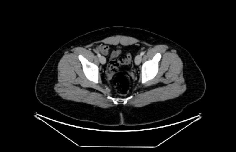 File:Adrenocortical carcinoma (Radiopaedia 80134-93438 Axial C+ portal venous phase 118).jpg