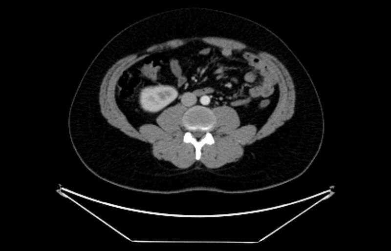 File:Adrenocortical carcinoma (Radiopaedia 80134-93438 Axial C+ portal venous phase 73).jpg