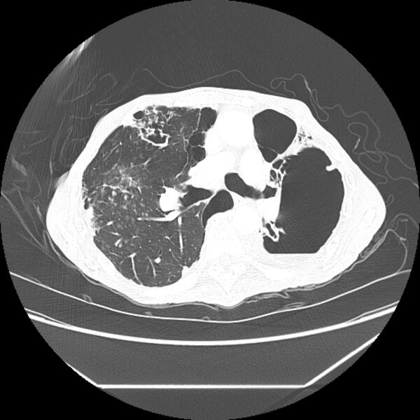 File:Advanced pulmonary tuberculosis (Radiopaedia 8599-9431 Axial lung window 22).jpg