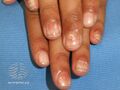 Alopecia areata nails (DermNet NZ alopecia-areata-nails).jpg
