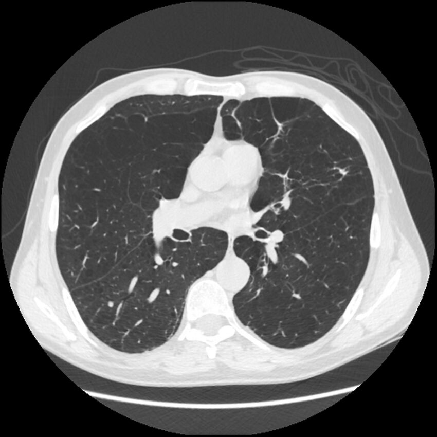 Alpha-1-antitrypsin deficiency (Radiopaedia 40993-43722 Axial lung window 120).jpg