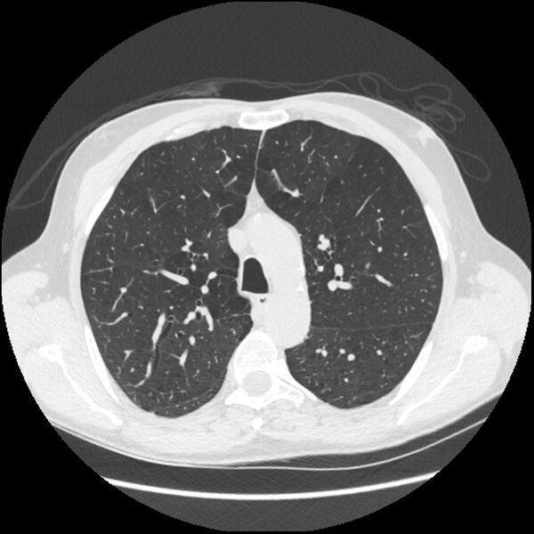 File:Alpha-1-antitrypsin deficiency (Radiopaedia 40993-43722 Axial lung window 74).jpg