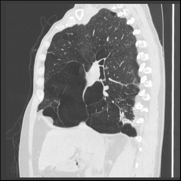 File:Alpha-1-antitrypsin deficiency (Radiopaedia 40993-43722 Sagittal lung window 159).jpg
