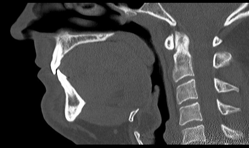 File:Ameloblastoma (Radiopaedia 33677-34806 Sagittal bone window 32).png