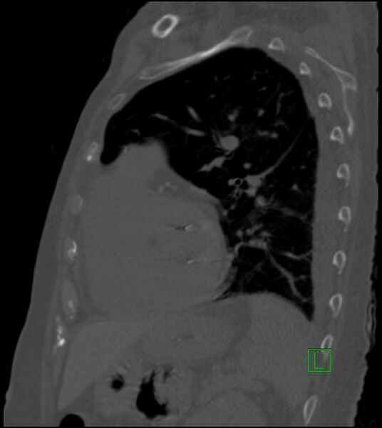 File:Amiodarone deposition in the liver (Radiopaedia 77587-89780 Sagittal bone window 33).jpg