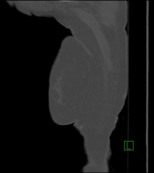 File:Amiodarone deposition in the liver (Radiopaedia 77587-89780 Sagittal bone window 99).jpg