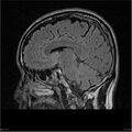 Amnestic syndrome secondary to hypoxic brain injury (Radiopaedia 24743-25004 D 12).jpg
