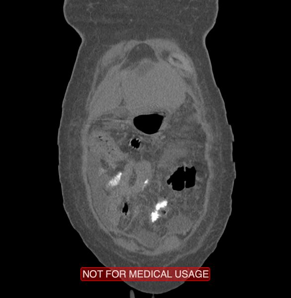File:Amoebic enterocolitis with liver abscess (Radiopaedia 35100-36609 B 4).jpg