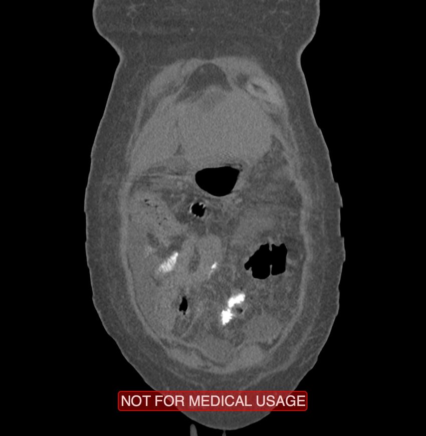 Amoebic enterocolitis with liver abscess (Radiopaedia 35100-36609 B 4).jpg