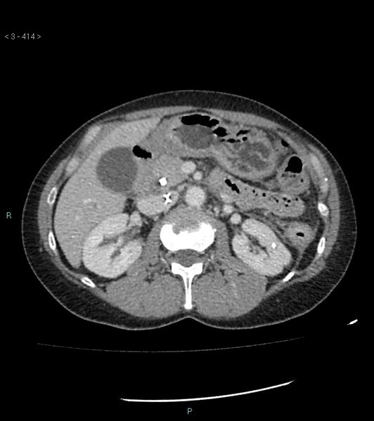 File:Ampulla of Vater metastasis (Radiopaedia 27820-28069 A 52).jpg