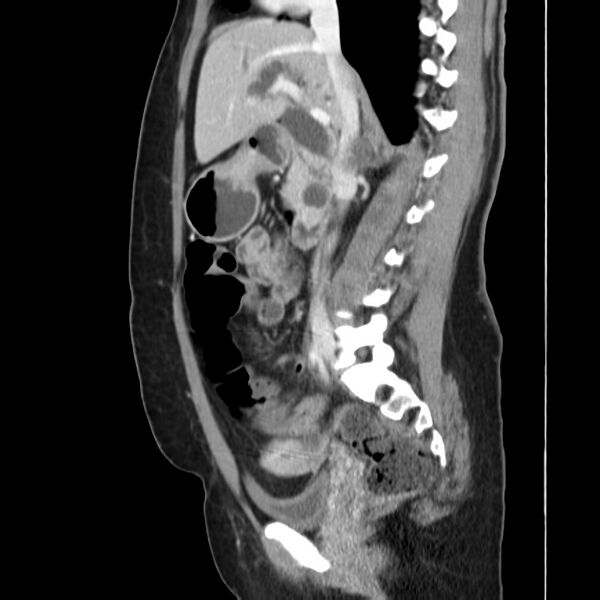 File:Ampullary tumor (Radiopaedia 22787-22816 D 25).jpg