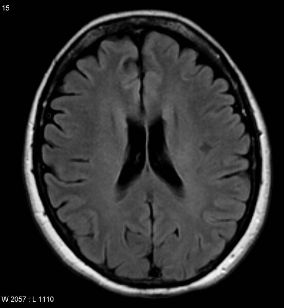 File:Amyotrophic lateral sclerosis (Radiopaedia 5373-7134 Axial FLAIR 15).jpg