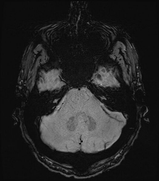 File:Amyotrophic lateral sclerosis (Radiopaedia 87352-103658 Axial SWI 8).jpg