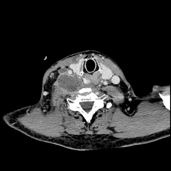 File:Anaplastic thyroid carcinoma (Radiopaedia 79087-92034 B 49).jpg