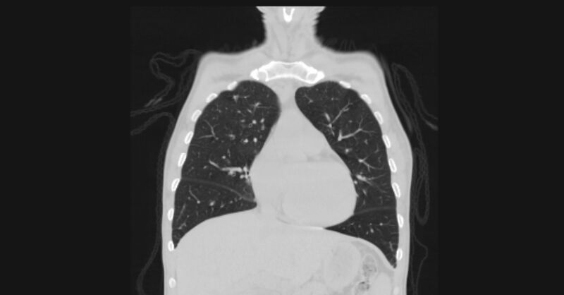 File:Angioinvasive aspergellosis (Radiopaedia 66995-76315 Coronal lung window 21).jpg