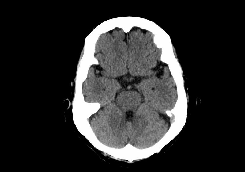 File:Anomalous intracranial venous drainage (Radiopaedia 28161-28418 Axial non-contrast 14).jpg