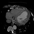 Anomalous left coronary artery from the pulmonary artery (ALCAPA) (Radiopaedia 40884-43586 A 61).jpg