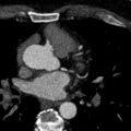 Anomalous origin of the left coronary artery with malignant course (Radiopaedia 77842-90126 C 43).jpeg