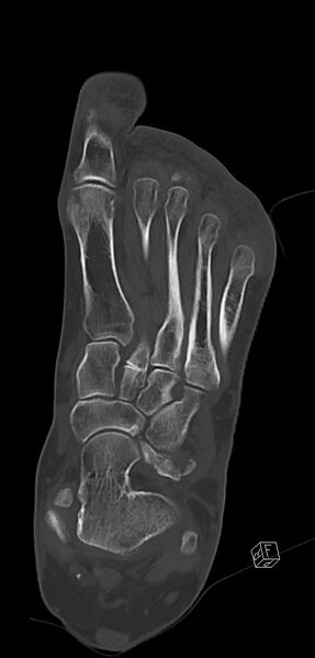 File:Anterior calcaneal process fracture (Radiopaedia 63353-71943 Coronal bone window 24).jpg