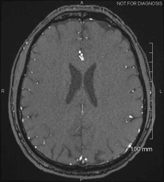 File:Anterior cerebral artery aneurysm (Radiopaedia 80683-94127 Axial MRA 163).jpg