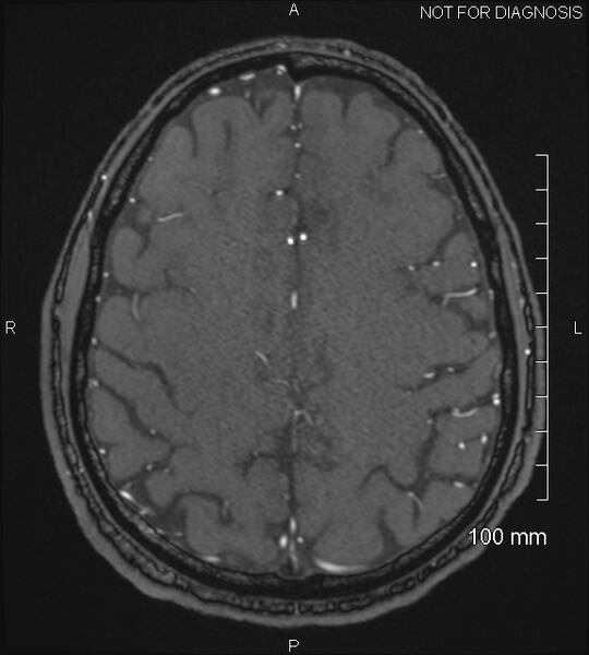File:Anterior cerebral artery aneurysm (Radiopaedia 80683-94127 Axial MRA 189).jpg