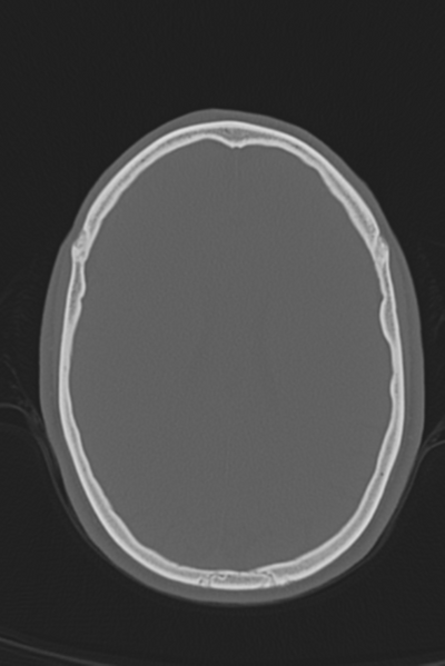 File:Anterior nasal spine fracture (Radiopaedia 46138-50494 Axial bone window 23).png