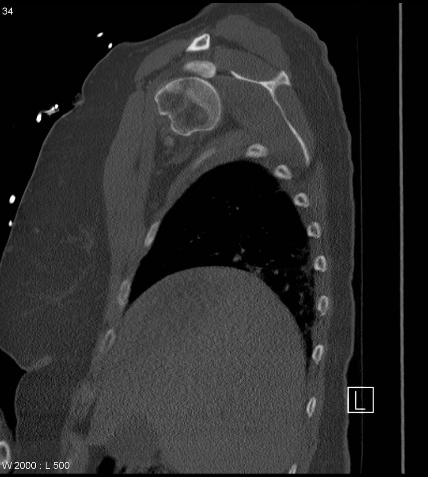 Anterior shoulder dislocation (CT) (Radiopaedia 59032-66309 Sagittal bone window 17).jpg