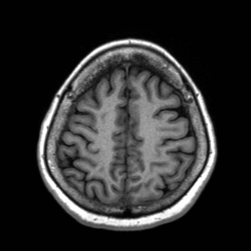 Anti-MOG encephalomyelitis (Radiopaedia 73831-84646 Axial T1 39).jpg