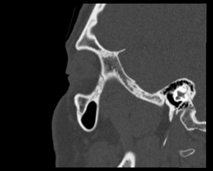 File:Antrochoanal polyp (Radiopaedia 21894-21868 Sagittal bone window 38).jpg