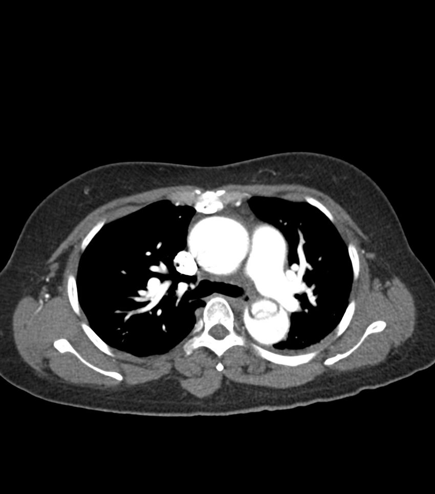 Aortic dissection with renal ischemia (Radiopaedia 76573-88338 A 22).jpg